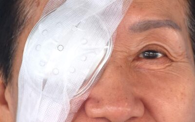 Pourquoi est-ce que je vois des « mouches volantes » après le laser pour cataracte secondaire ?