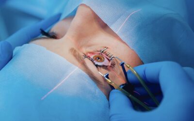 Qu&rsquo;est-ce que la chirurgie réfractive de l&rsquo;œil ?